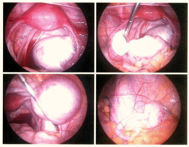 Endometriosis Surgery